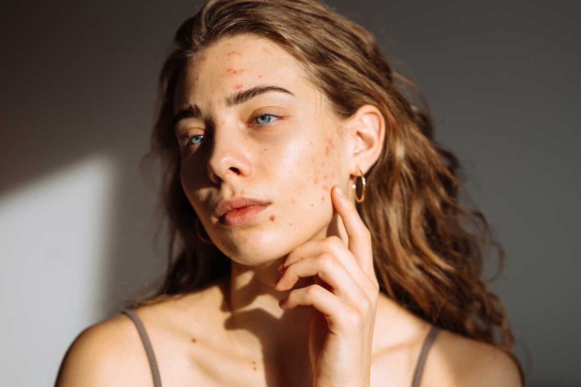 Jauna moteris su lengvais bėrimais ir paraudimu veido srityje